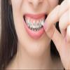 Genuine Orthowax - Orthodontic Wax for Braces Wearer - Stick Better Than competitors view 3