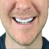 Instant Smile Flex 2pk - Bright White Shade - One Size Fits Most. Fix Your Smile at Home in Minutes! Comfortable Upper Cosmetic Veneer for A Perfect Smile! view 2