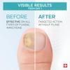 PODERM - FUNGAL NAIL TREATMENT - Nail Fungus Treatment for Toenail - Exceptional and Powerful Plants Anti-Fungal Restorative Properties - Professional Foot/Hand Treatment - Quick&Easy - Swiss Made view 3