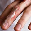 Lecoxen cream re-epithelizing and healing adjuvant. For scars and any kind of wound, prevents the formation of keloid. With vegetal extracts. 30 ml view 4