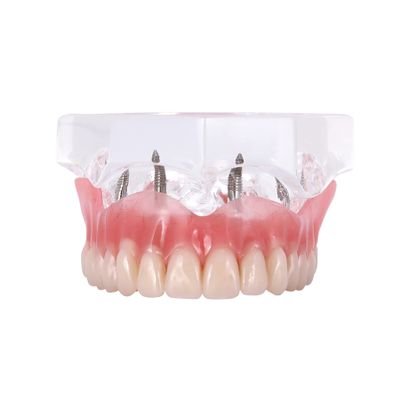 DENTALMALL Dental Upper Implants Model Overdenture with 4 Superior Teeth Demo Transparent Vision for Education and Study Model Tool