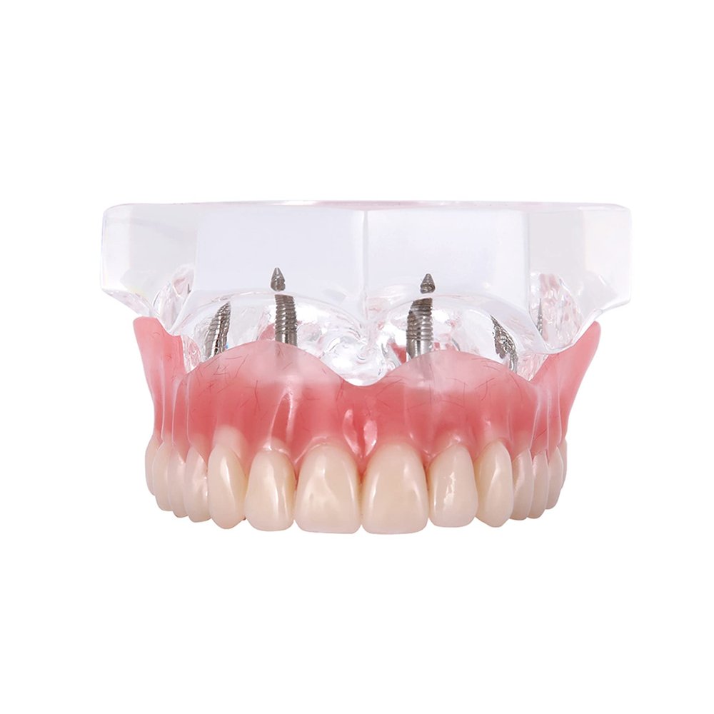 DENTALMALL Dental Upper Implants Model Overdenture with 4 Superior Teeth Demo Transparent Vision for Education and Study Model Tool