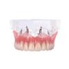 DENTALMALL Dental Upper Implants Model Overdenture with 4 Superior Teeth Demo Transparent Vision for Education and Study Model Tool view 1