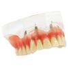 DENTALMALL Dental Upper Implants Model Overdenture with 4 Superior Teeth Demo Transparent Vision for Education and Study Model Tool view 2