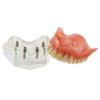 DENTALMALL Dental Upper Implants Model Overdenture with 4 Superior Teeth Demo Transparent Vision for Education and Study Model Tool view 3