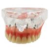 DENTALMALL Dental Upper Implants Model Overdenture with 4 Superior Teeth Demo Transparent Vision for Education and Study Model Tool view 4