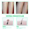 TailaiMei Exfoliating Brush for Ingrown Hair Treatment - to Treat and Prevent Bikini Bumps, Razor Bumps - Silky Smooth Skin Solution for Men and Women view 3
