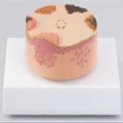 AW Skin Cancer Model (J55)