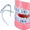 Comfort Cover for Braces, Lip Protector Mouth Guard Lip Cushion Teeth Shield Bumper for Brackets, Aligner, Dental Wax Alternative, Hard and Rigid Clip view 1