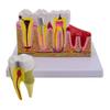 HeineScientific 2-Piece Model of Dental Damage and Sicks view 2