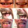 Temporary Tooth Repair Kit Instant Perfect Smile False Teeth Adhesive for Missing Tooth Replacement, 5 PCS,Darkshade5PCS view 4