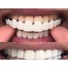 MUYEY 1 Set Perfect Smile Teeth Veneers Top and Bottom Fake Cosmetic Teeth Veneers Instant Comfort Fit Whitening Flex Denture Cover view 3