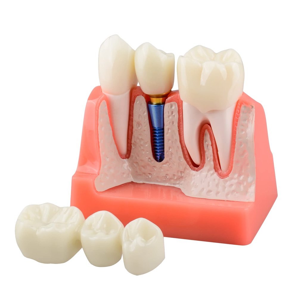 Dental Implant Model with Crown Bridge and Removeable Crowns for Education-Normal