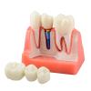 Dental Implant Model with Crown Bridge and Removeable Crowns for Education-Normal view 1