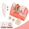 Dental Implant Model with Crown Bridge and Removeable Crowns for Education-Normal view 2