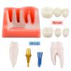 Dental Implant Model with Crown Bridge and Removeable Crowns for Education-Normal view 3
