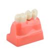 Dental Implant Model with Crown Bridge and Removeable Crowns for Education-Normal view 4
