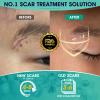 ScarMD Silicone Scar Gel - 6g - Scar Cream, Scar Removal for Acne, Surgery, C-Section & Stretch Marks - Natural Occurring Silicones & Vitamin E Scar Treatment, Scar Removal Cream Reduce Discomfort view 4