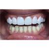 Real Instant Perfect Dental Oral Care Snap Smile False Teeth Tooth Cover Veneers Whitening Whitener Dentures view 4
