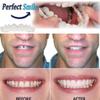 XZLZMD Silica Prosthesis Top and Bottom Tooth Dentures Reusable Care Veneers Cosmetic Natural Color Lnstant repair of Cracked or Missing Dental for Perfect Smile,4 pair view 3