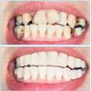 XZLZMD Silica Dentures Lnstant repair of Cracked or Missing Dental Dental Temporary False Teeth Top and Bottom Tooth Cover Alternative Dentures for Men and Women,3 pairs view 4
