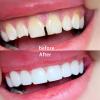Temporary Tooth Repair Kit Fix Broken Teeth Dental Repair Kit Tooth Bead Tooth Filling Replacement False Teeth Adhesive Thermal Fitting Beads Tooth Veneer for Missing Cracked Chipped Chipped Tooth view 4