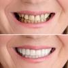 2 Pairs of Upper and Lower Teeth Veneers, Smile Instant Temporary Teeth Kit Decor, Perfect Braces and Whitening Alternatives for Everyone view 3