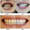 MXRFACTory Fake Teeth Instant Veneers Natural Tones Top Bottom Dentures Silicone Temporary Dentures Reusable Teeth Braces Covering for Men and Women Fix Your Teeth and Smile Fast,13pairs view 4