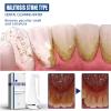 UIHECTA Dissolving Dental Spray, Dental Calculus Remover Teeth Cleaner, Mouth Refreshing Spray,Intensive Stain Removal Toothpaste Clean Mouth Dental Calculus Remover Teeth view 2