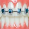 Snapcaps Braces Bumper Cover, Orthodontic Bracket Wax Substitute, Alternative Snap-on Braces Guard Braces Accessories 10 pack (Butterfly) view 1