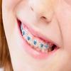 Snapcaps Braces Bumper Cover, Orthodontic Bracket Wax Substitute, Alternative Snap-on Braces Guard Braces Accessories 10 pack (Butterfly) view 2