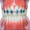 Snapcaps Braces Bumper Cover, Orthodontic Bracket Wax Substitute, Alternative Snap-on Braces Guard Braces Accessories 10 pack (Butterfly) view 4