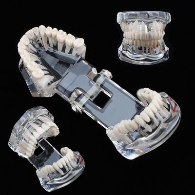 UIGJIOG Dental Tooth Model Dental Implant Model Dental Pathologies Adults Transparent Dentist Demonstration Periodontal Disease Love of Teeth Care Teeth Removable Model