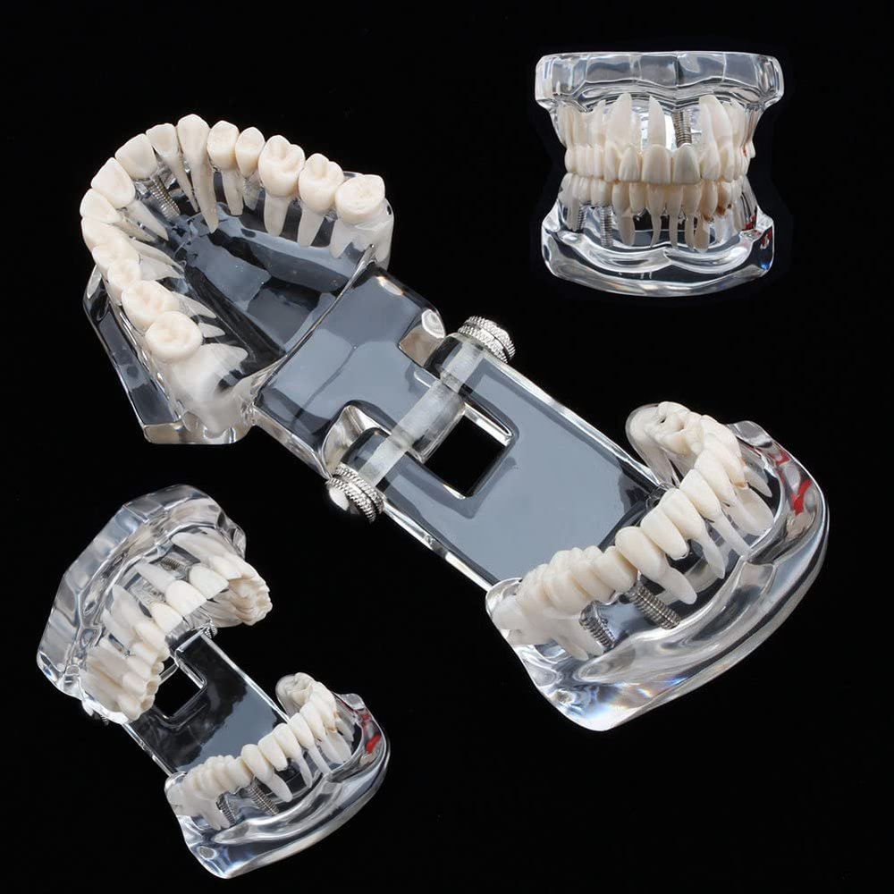 UIGJIOG Dental Tooth Model Dental Implant Model Dental Pathologies Adults Transparent Dentist Demonstration Periodontal Disease Love of Teeth Care Teeth Removable Model