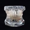 UIGJIOG Dental Tooth Model Dental Implant Model Dental Pathologies Adults Transparent Dentist Demonstration Periodontal Disease Love of Teeth Care Teeth Removable Model view 2