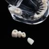 UIGJIOG Dental Tooth Model Dental Implant Model Dental Pathologies Adults Transparent Dentist Demonstration Periodontal Disease Love of Teeth Care Teeth Removable Model view 4