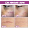 FASSME Scar Remover,Burn Repair Balm for Face and Body - Moisturizing Scar Treat for Surgical Scars, C Section, Burn, Keloids & Injuries Scars view 4