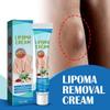 CurSkin Lipoma Treatment Ointment,LumpFree Lipoma Removal Cream,Herbal Lipoma Lumps Removal Creams,Herbal Lipoma Elimination Cream,Get Rid of Your Fatty Lipoma Lumps view 2