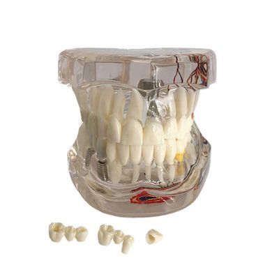Dental Implant Disease Teeth Model Transparent Tooth Pathological Model Removable Teeth Neural Repair Dental Teeth Model for Patient Education