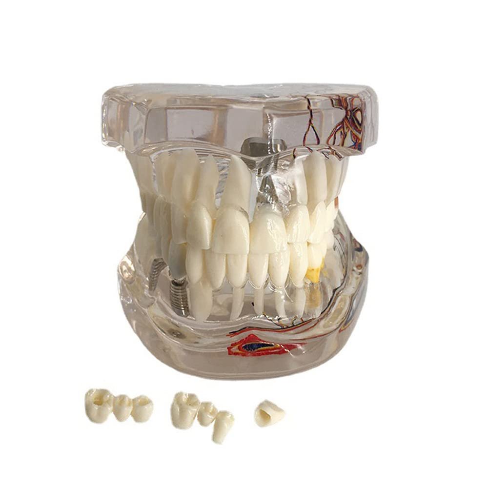 Dental Implant Disease Teeth Model Transparent Tooth Pathological Model Removable Teeth Neural Repair Dental Teeth Model for Patient Education