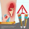 Bed Sore Treatment Cream, Bedsore Ointment, Bed Sores Healing Cream, Fast Wound Healing Gel, Fast-Acting Healing Cream for Bed Sores (3PC) view 2