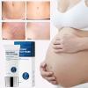 Yunmiao 5 Scar Removal Cream - Stretch Mark Prevention Cream for Pregnancy | Belly Butter Pregnancy Stretch Mark Remover Cream for Stretch Marks and Scar Removal view 3