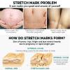 Yunmiao 5 Scar Removal Cream - Stretch Mark Prevention Cream for Pregnancy | Belly Butter Pregnancy Stretch Mark Remover Cream for Stretch Marks and Scar Removal view 4