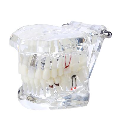 Dental Teeth Model, Transparent Disease Teeth Model with Removable Teeth, High Degree Of Simulation, for Practicing Restorative Kids Dental Teaching, Clean Display