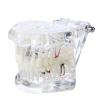 Dental Teeth Model, Transparent Disease Teeth Model with Removable Teeth, High Degree Of Simulation, for Practicing Restorative Kids Dental Teaching, Clean Display view 1