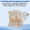 Dental Teeth Model, Transparent Disease Teeth Model with Removable Teeth, High Degree Of Simulation, for Practicing Restorative Kids Dental Teaching, Clean Display view 2