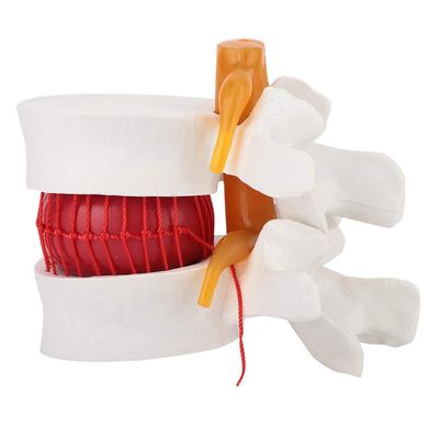1:1.5 Medical Demon Ion Model of Lumbar Vertebral Spine Human Lumbar Disc Herniation Model Gonetre 14 * 13 * 12 e Dental Models