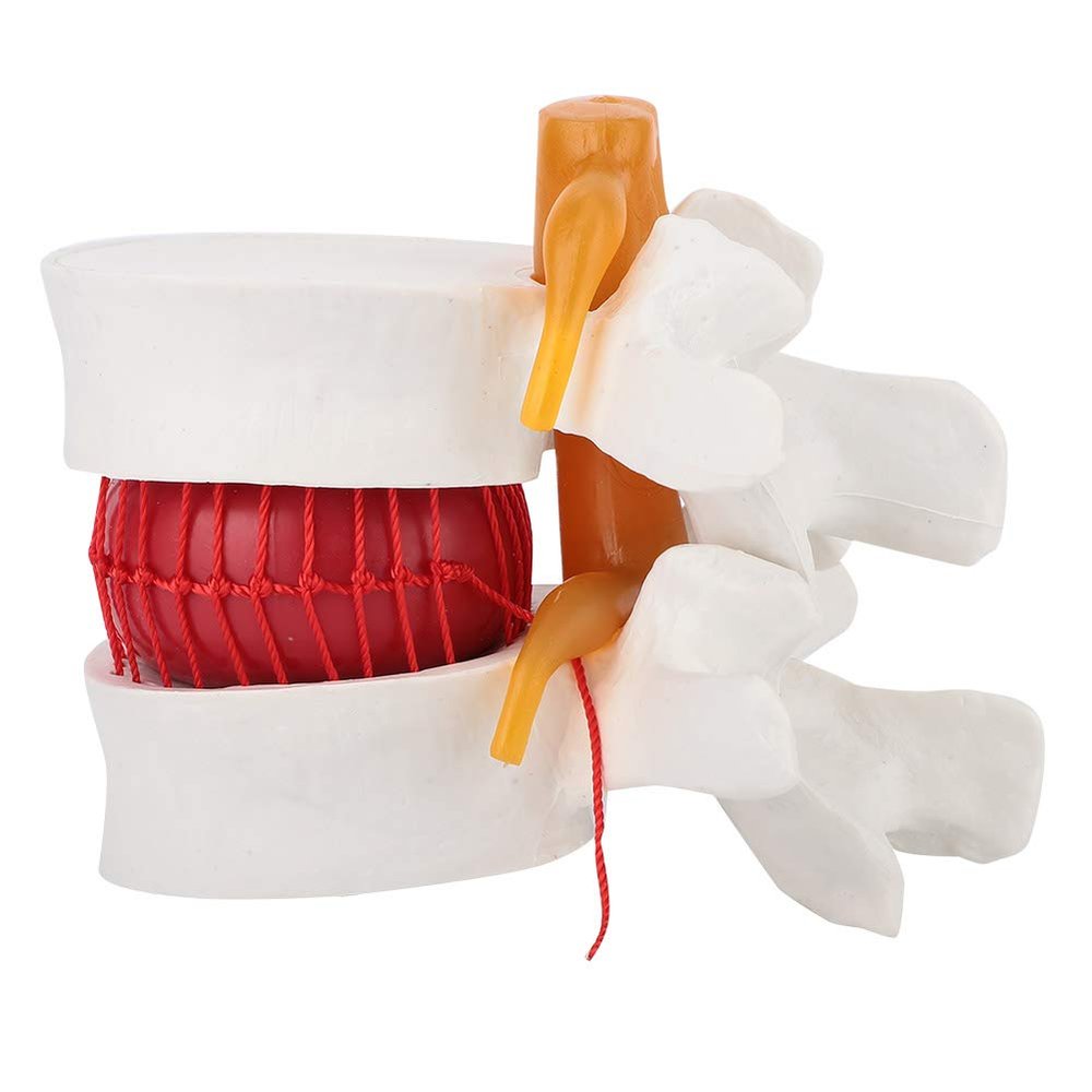 1:1.5 Medical Demon Ion Model of Lumbar Vertebral Spine Human Lumbar Disc Herniation Model Gonetre 14 * 13 * 12 e Dental Models