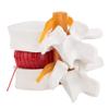 1:1.5 Medical Demon Ion Model of Lumbar Vertebral Spine Human Lumbar Disc Herniation Model Gonetre 14 * 13 * 12 e Dental Models view 2