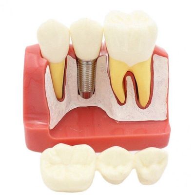 4 Times Dental Implant Model Enlarged Size Removable Analysis Crown Bridge Demonstration Teeth Model